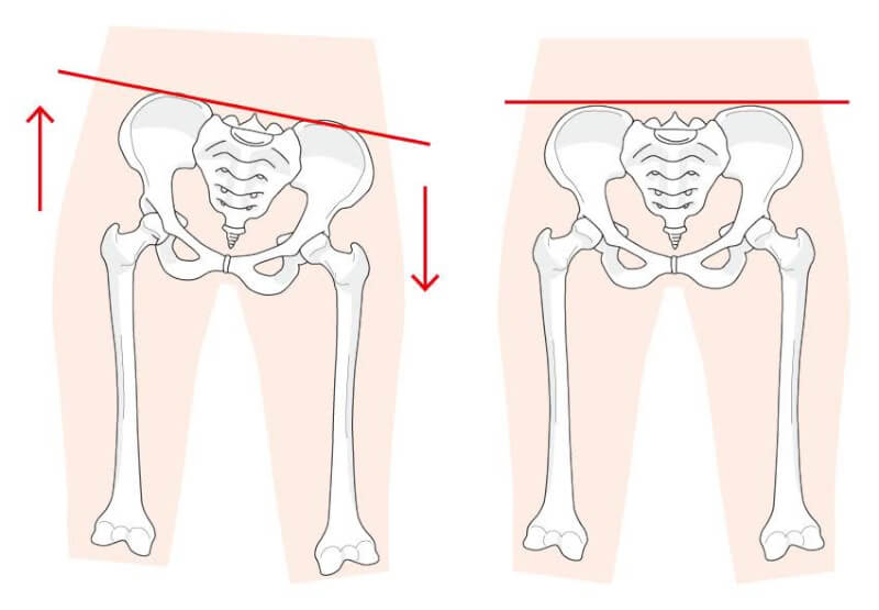 股関節術後の脚長差